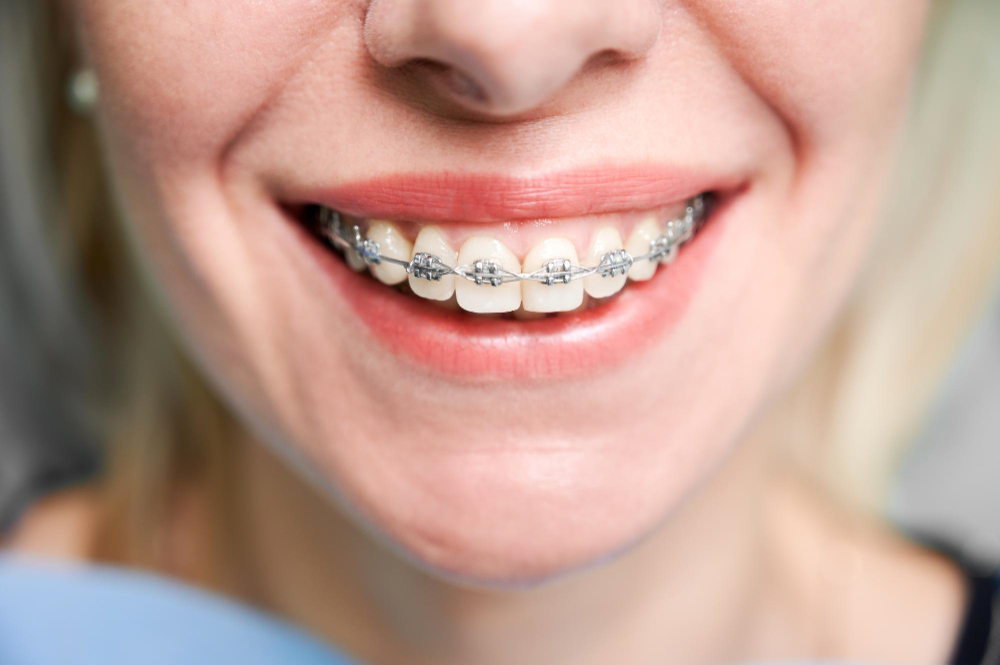 orthodontic services Germantown, MD , Manassas, VA